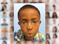脸部识别新用途：帮助医生检测罕见遗传病 